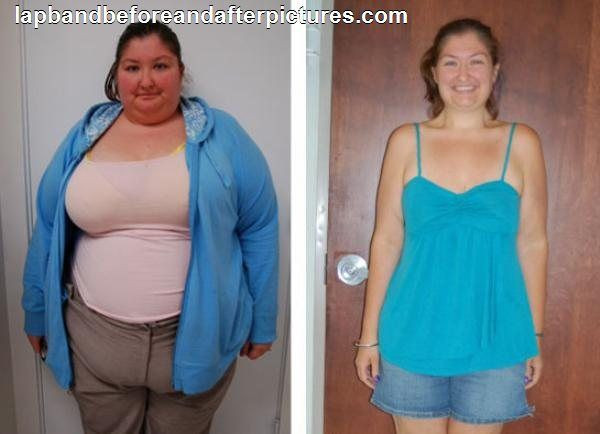 After Weight Loss Surgery
 20 best Bariatric Surgery Before & After images on