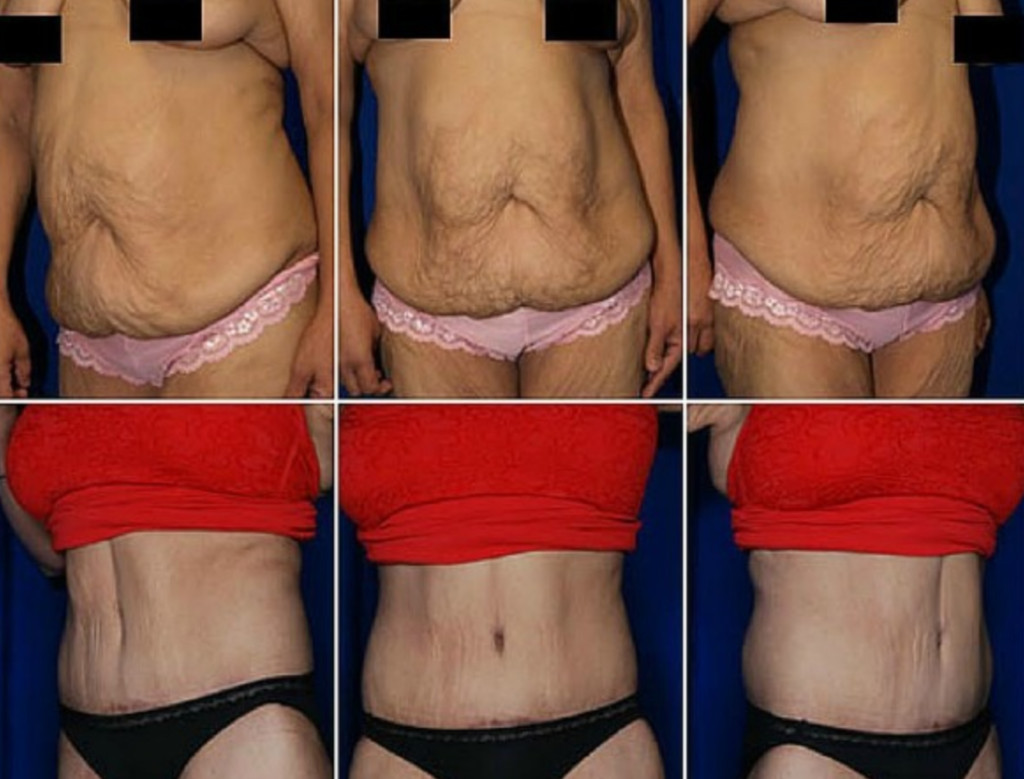 After Weight Loss Surgery
 Top 7 Plastic Surgery Procedures for Extreme Weight Loss