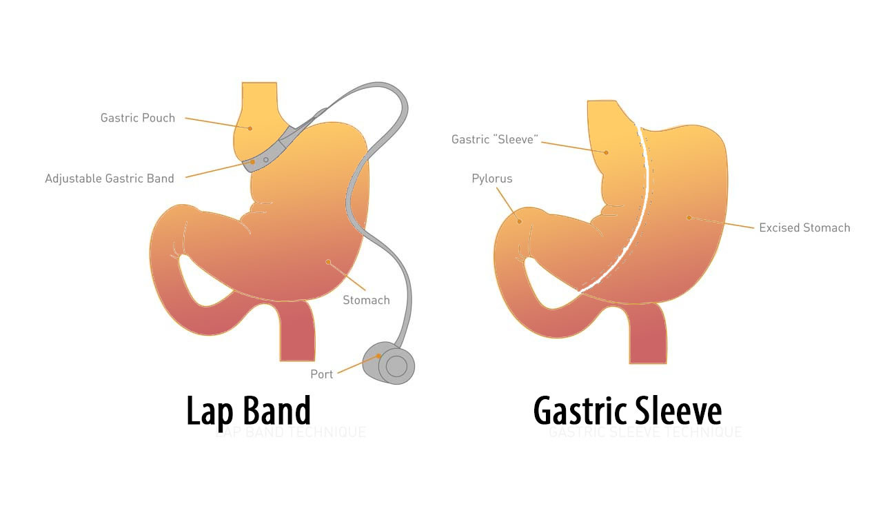 Gastric Bypass Vs Sleeve Weight Loss Surgery
 paring Objectively the Gastric Sleeve Vs Gastric Bypass