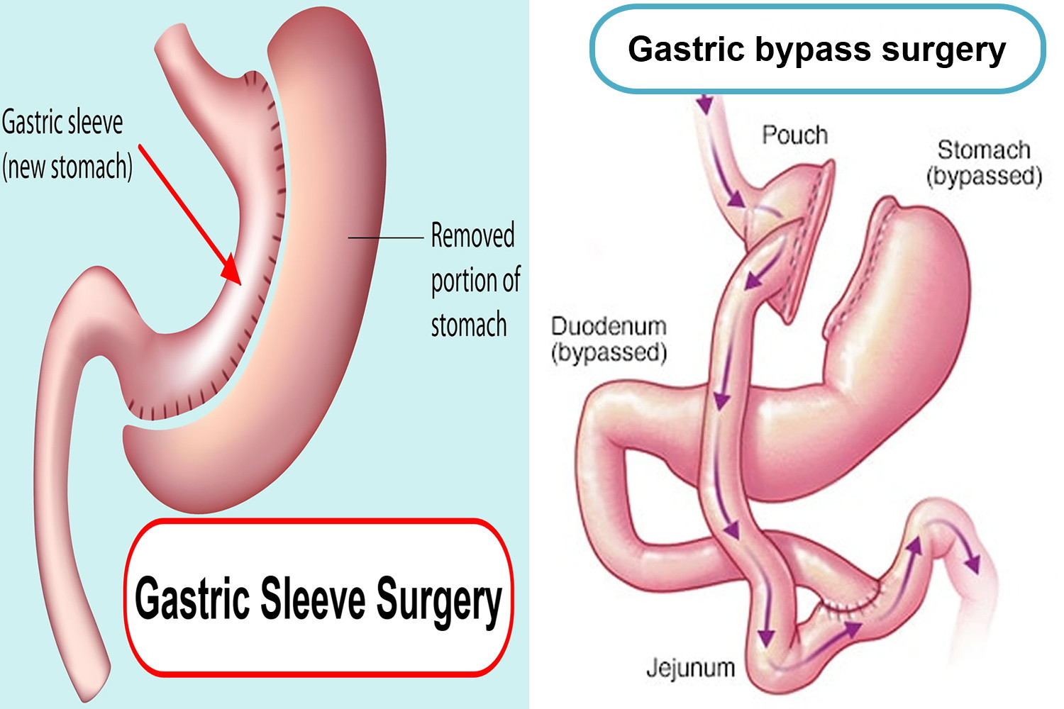 Gastric Bypass Vs Sleeve Weight Loss Surgery
 Gastric Sleeve Reviews Surgery plications Recovery