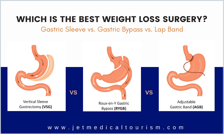 Gastric Bypass Vs Sleeve Weight Loss Surgery
 Gastric Sleeve vs Bypass vs Lap Band Which is Best Weight