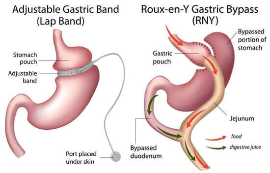 Gastric Bypass Vs Sleeve Weight Loss Surgery
 Converting a Gastric Band to a Laparoscopic Gastric Bypass