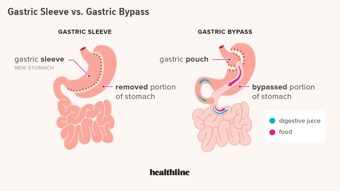 Gastric Bypass Vs Sleeve Weight Loss Surgery
 Gastric Sleeve vs Gastric Bypass Differences Pros Cons