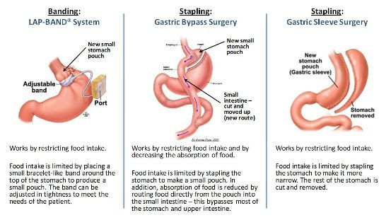 Gastric Bypass Vs Sleeve Weight Loss Surgery
 paring Lap Band with Gastric Sleeve and Gastric Bypass