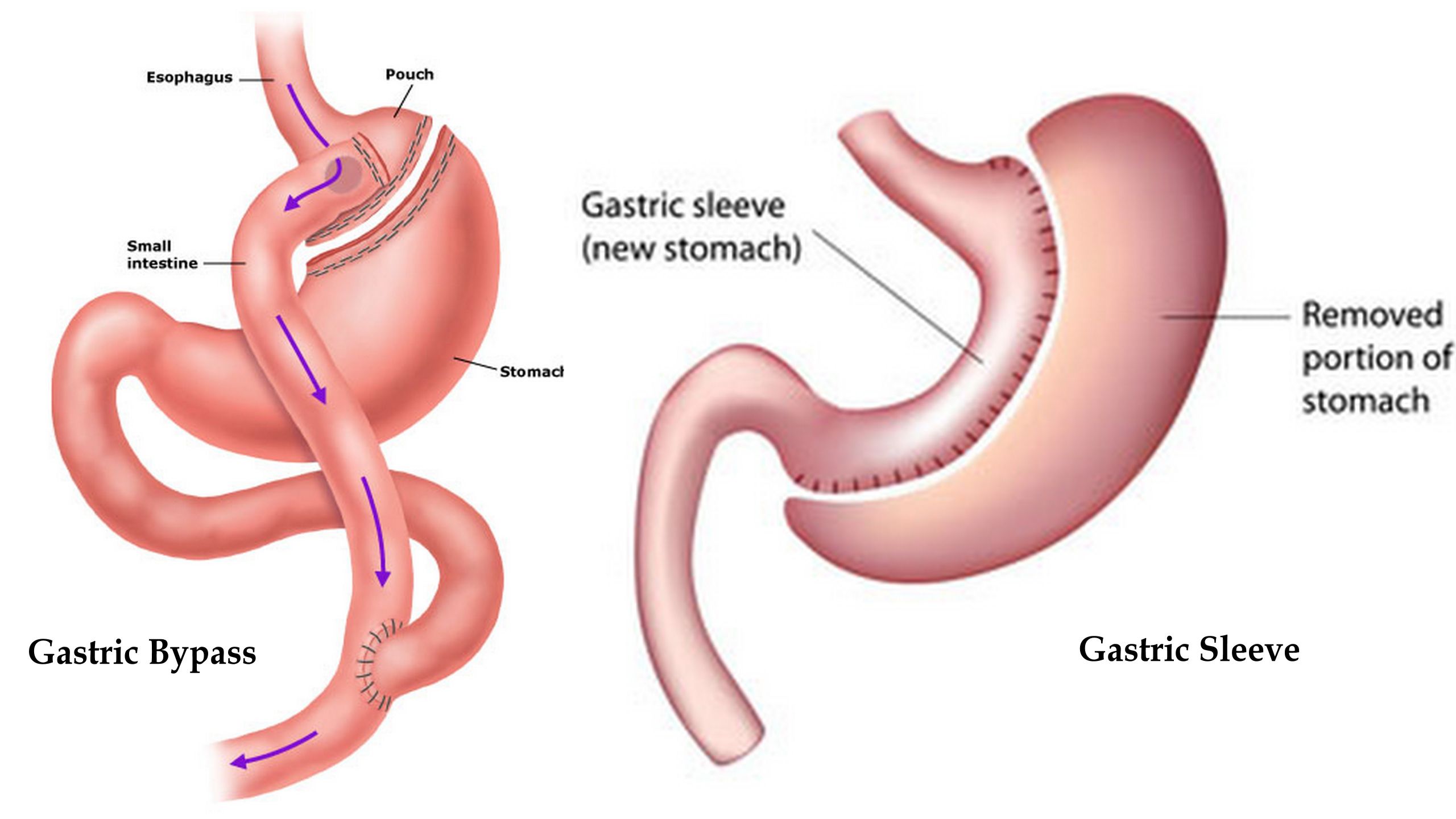 Gastric Bypass Vs Sleeve Weight Loss Surgery
 Gastric Bypass Is it REALLY the easy way out Elite