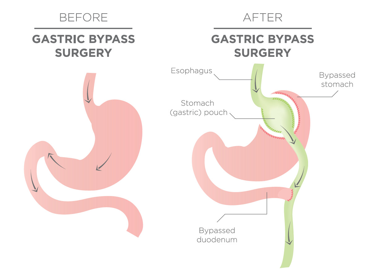 Gastric Bypass Vs Sleeve Weight Loss Surgery
 Gastric Bypass Surgery & Cost The Surgical Weight Loss
