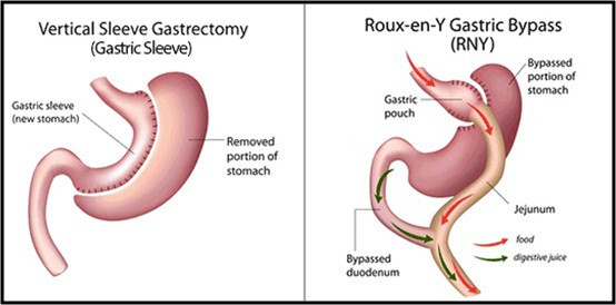 Gastric Bypass Vs Sleeve Weight Loss Surgery
 Gastric Sleeve And Gastric Bypass Surgery pared