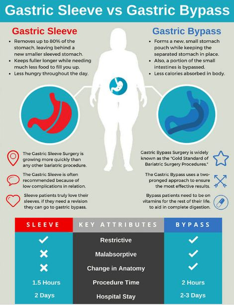 Gastric Bypass Vs Sleeve Weight Loss Surgery
 Gastric Sleeve vs Gastric Bypass Infographics