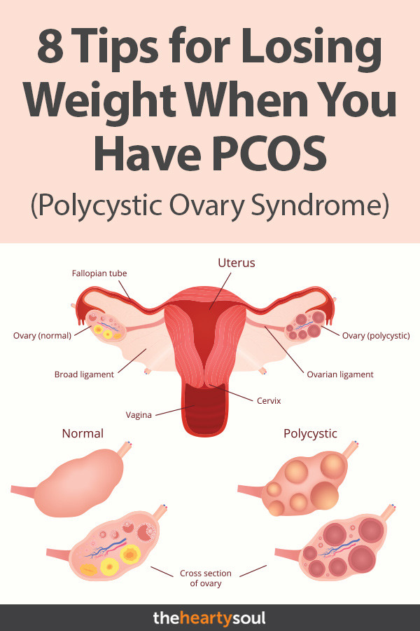 How To Lose Weight With Pcos
 How to Lose Weight Even If You Have PCOS 8 Science Backed