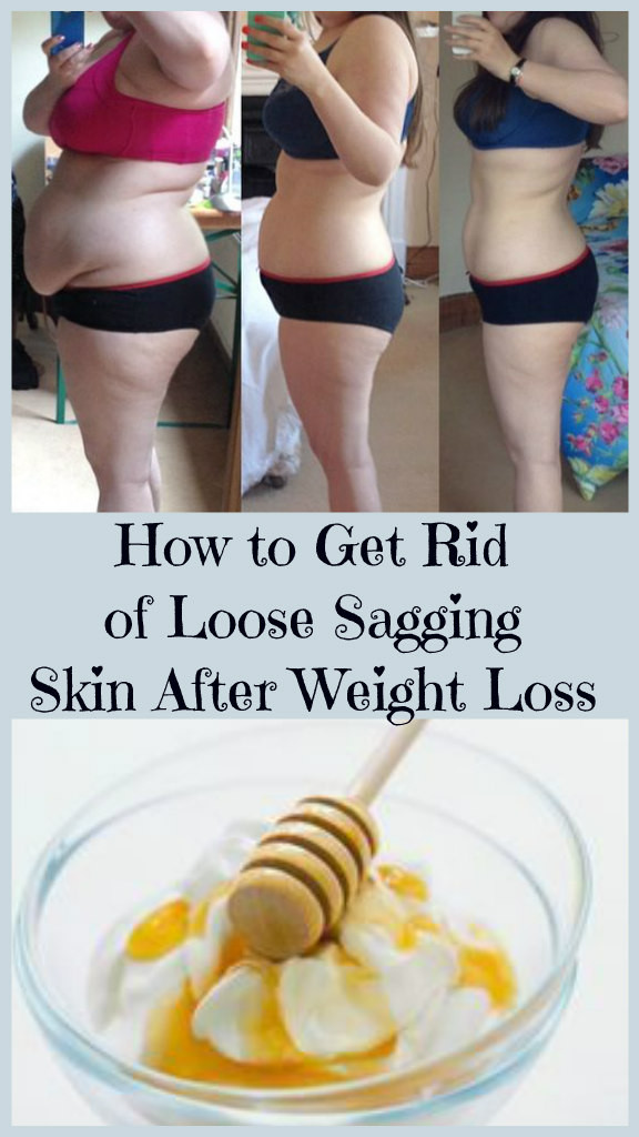 Sagging Skin After Weight Loss Exercise
 How To Get Rid Loose Sagging Skin After Weight Loss