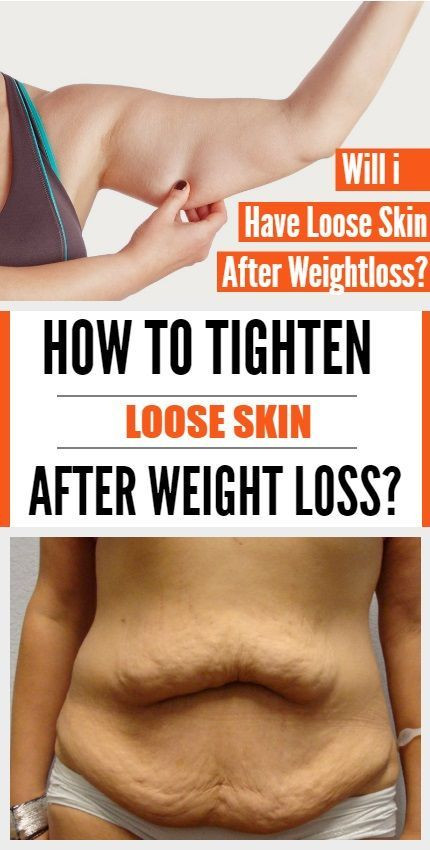 Sagging Skin After Weight Loss Exercise
 The 25 best Tighten loose skin ideas on Pinterest