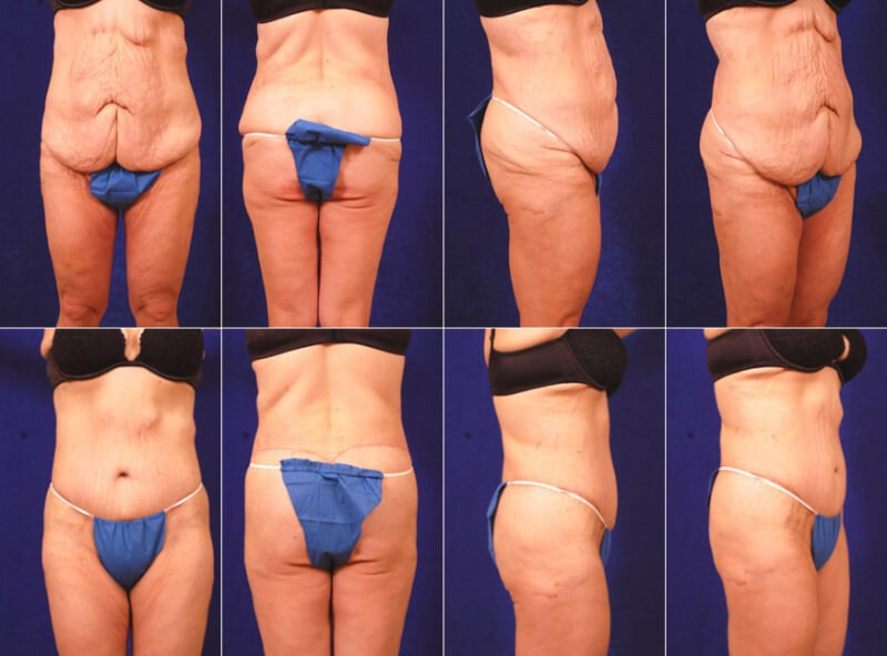 Tummy Tuck After Weight Loss Surgery
 Austin Woman has Weight Loss Surgery Tummy Tuck with Exparel