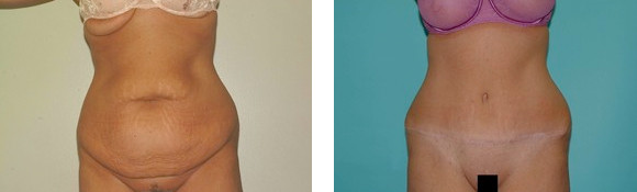 Tummy Tuck After Weight Loss Surgery
 Before and After Tummy Tuck s Dr Jeffrey Poulter