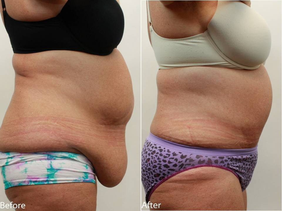 Tummy Tuck After Weight Loss Surgery
 Abdominoplasty Tummy Tuck After Weight Loss Surgery