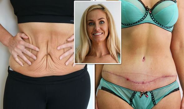 Tummy Tuck After Weight Loss Surgery
 Weight loss Josie Gibson reveals tummy tuck BEFORE and