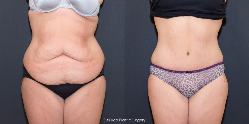 Tummy Tuck After Weight Loss Surgery
 TUMMY TUCK BEFORE AND AFTER WEIGHT LOSS burmes fede