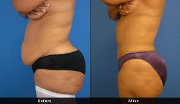 Tummy Tuck After Weight Loss Surgery
 Abdominoplasty or "tummy tuck" is a cosmetic surgery