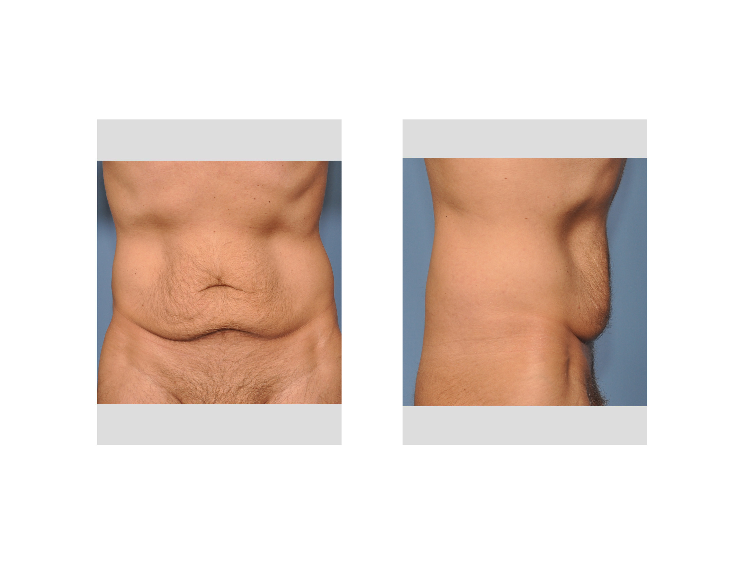 Tummy Tuck After Weight Loss Surgery
 male tummy tuck Archives