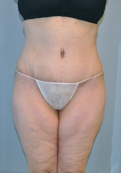 Tummy Tuck After Weight Loss Surgery
 Tummy Tuck Abdominoplasty