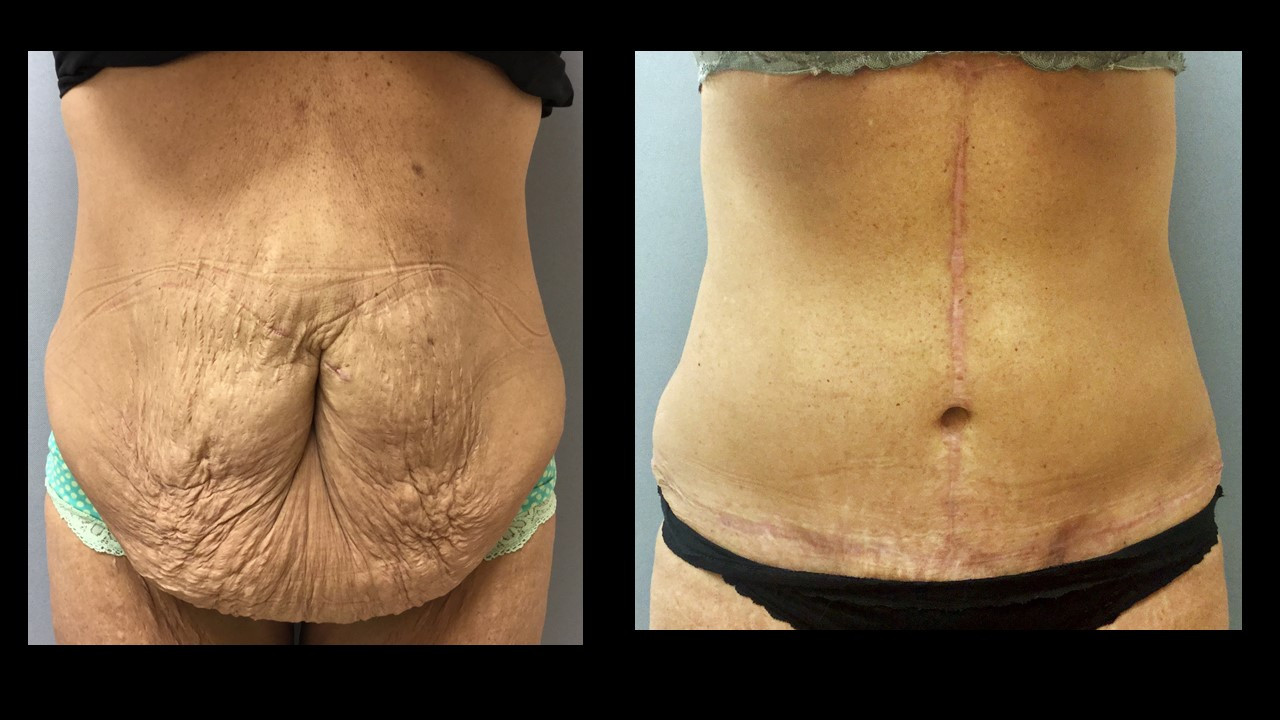 Tummy Tuck After Weight Loss Surgery
 Tummy Tuck After Massive Weight Loss – Baltimore Plastic