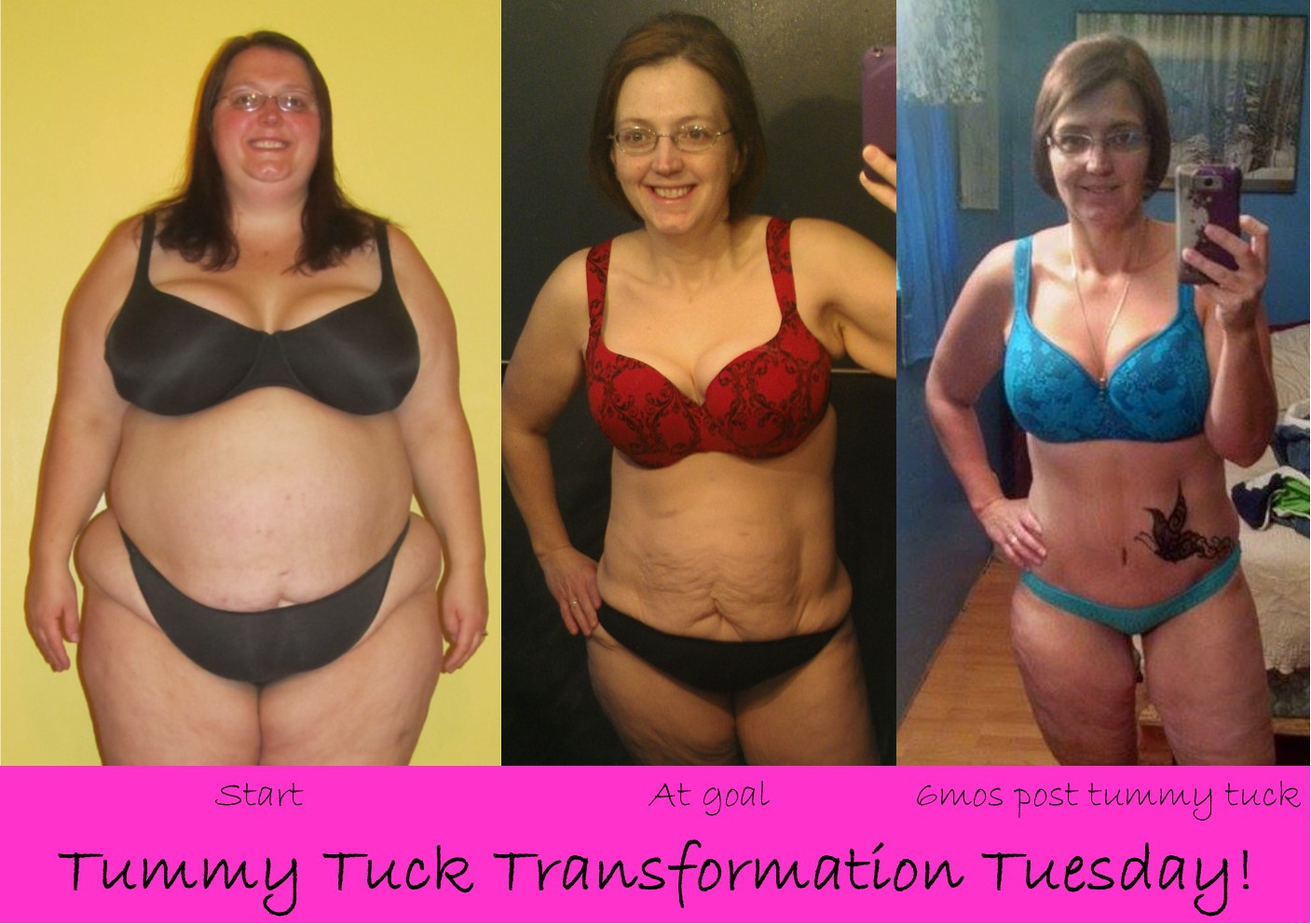 Tummy Tuck After Weight Loss Surgery
 A Lesser Jen 3yr 9 mo Weight loss and 6 mo Tummy Tuck updates