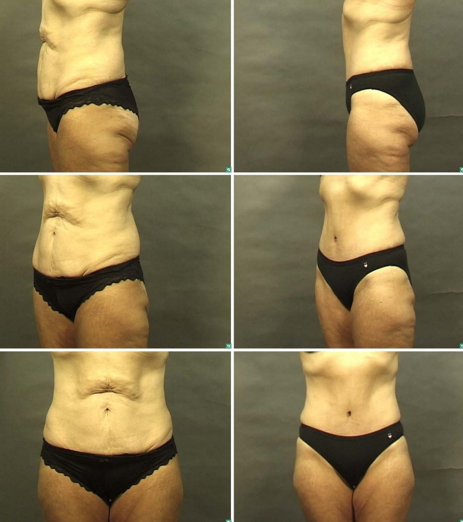 Tummy Tuck After Weight Loss Surgery
 Dallas Plastic Surgery After Massive Weight Loss