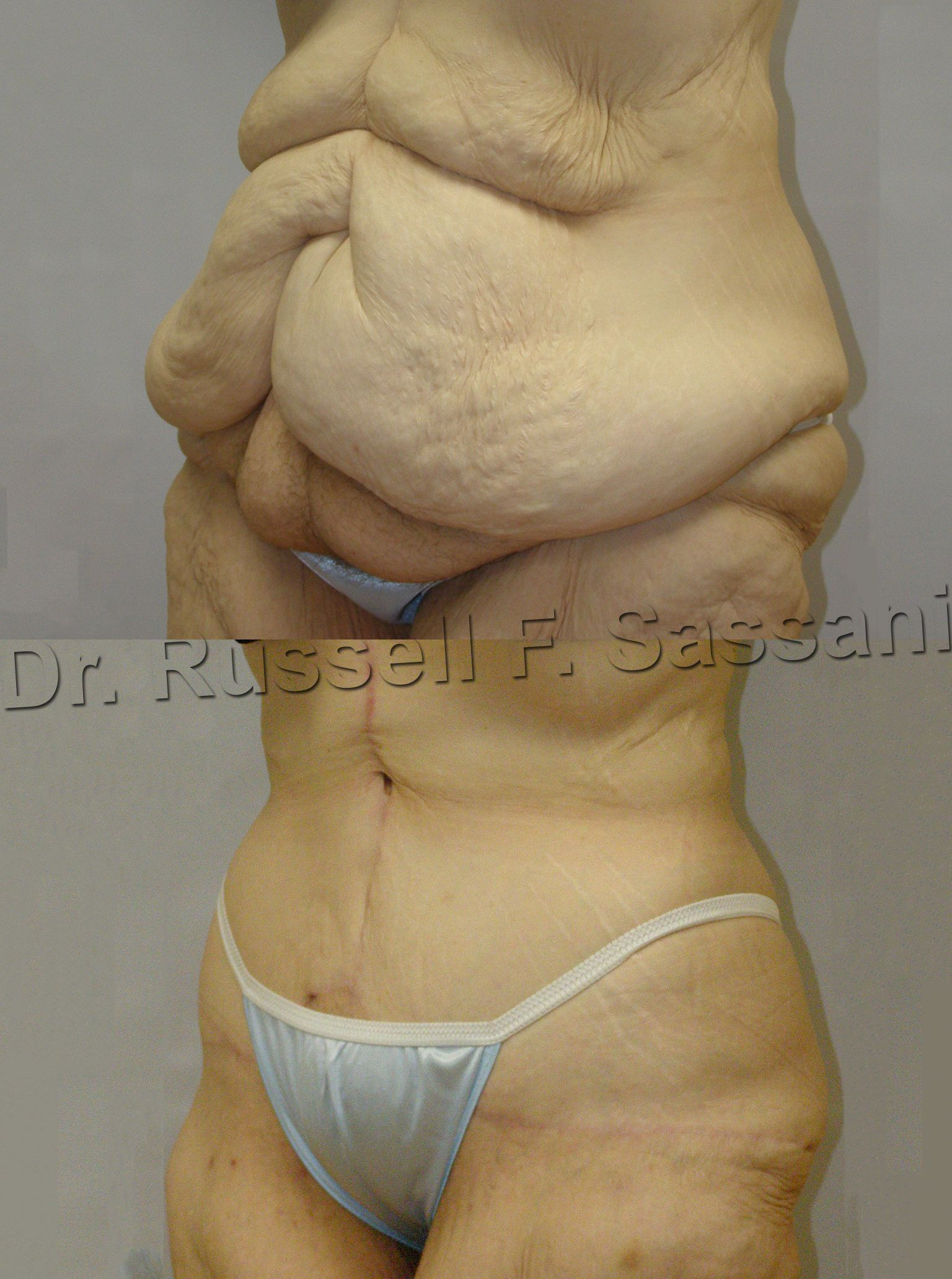 Tummy Tuck After Weight Loss Surgery
 Pin on Tummy Tuck and Body Contouring