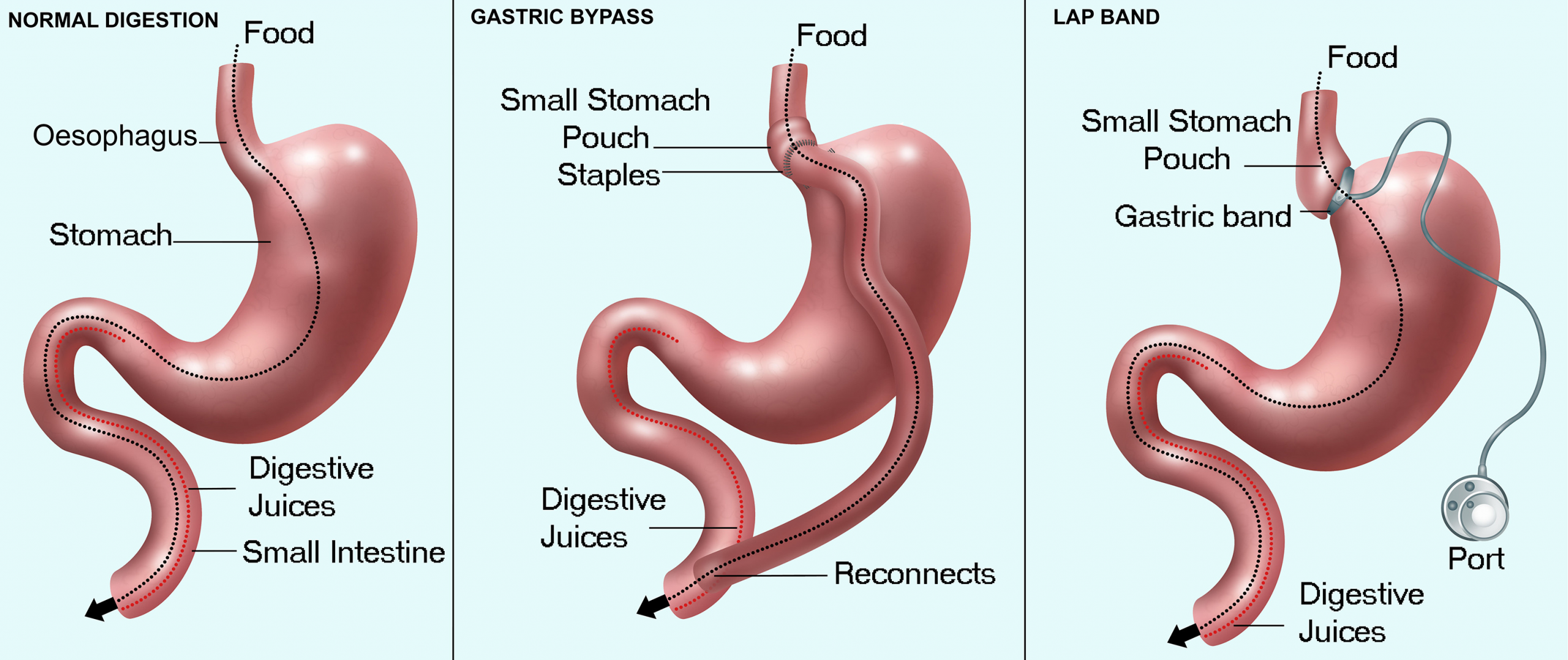 Types Of Weight Loss Surgery
 Bariatric Surgery – Obesity Meeting 2019