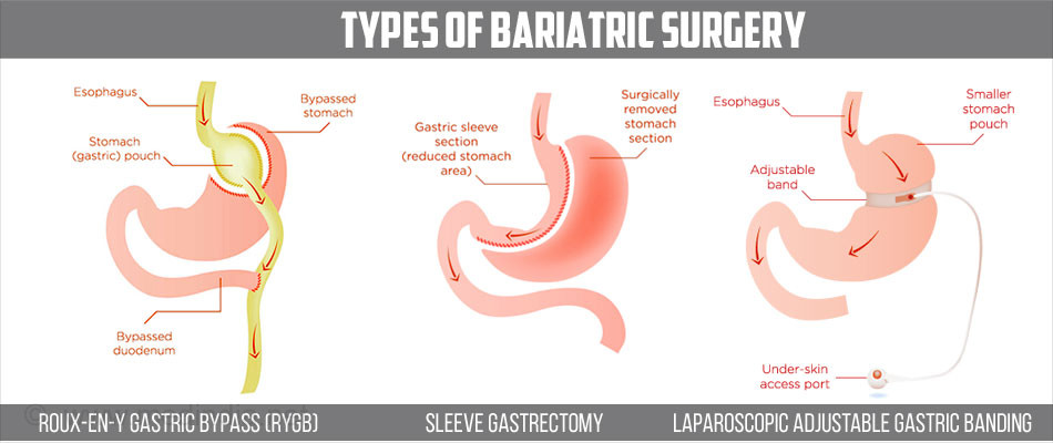 Types Of Weight Loss Surgery
 Bariatric Surgery Short Term and Long Term Out es