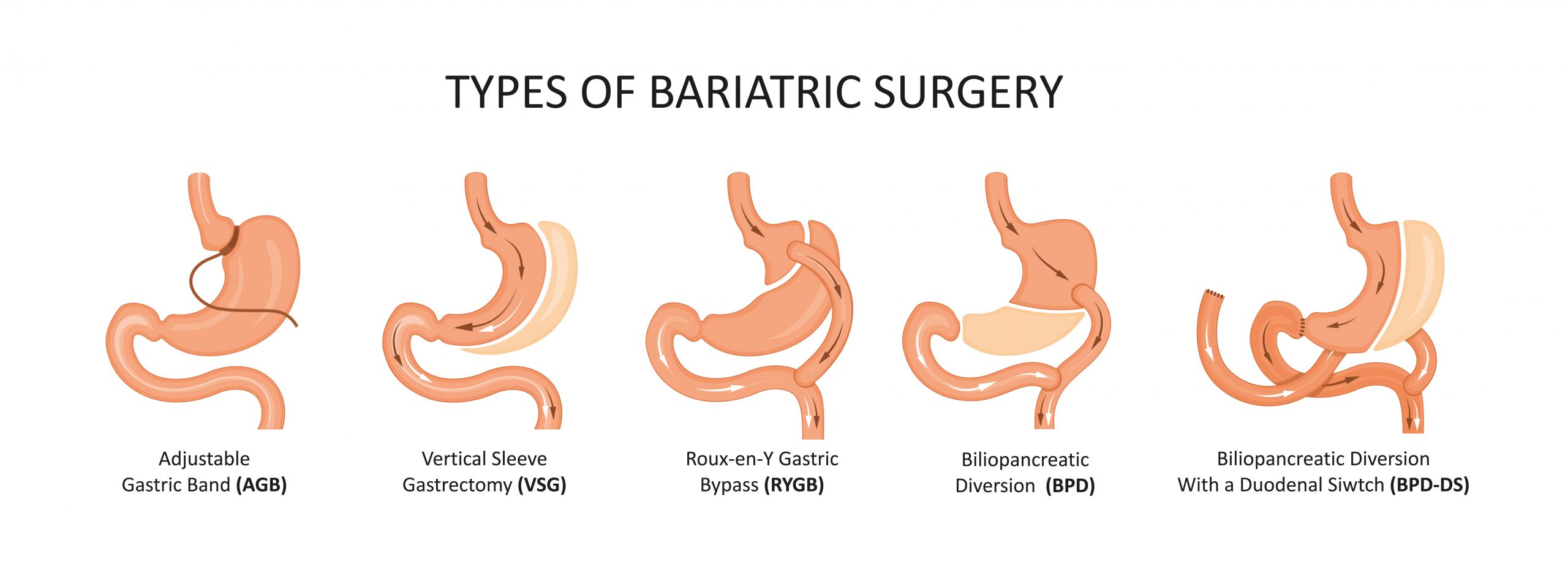 Types Of Weight Loss Surgery
 Bariatric Surgery Types Risk Cost & plications
