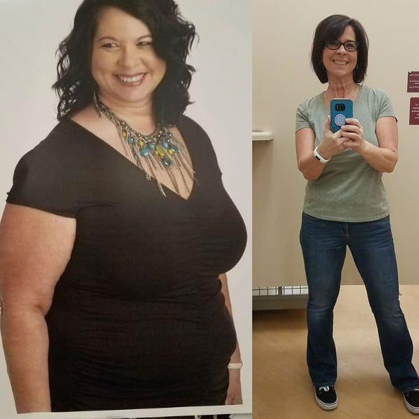 Vsg Before And After Sleeve Weight Loss Surgery
 Gastric Sleeve Before and After s The Best