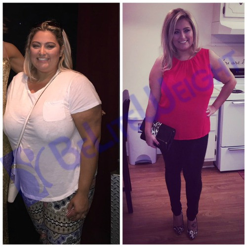 Vsg Before And After Sleeve Weight Loss Surgery
 Karina s 2 4 and 6 Month Sleeve Story BeLiteWeight