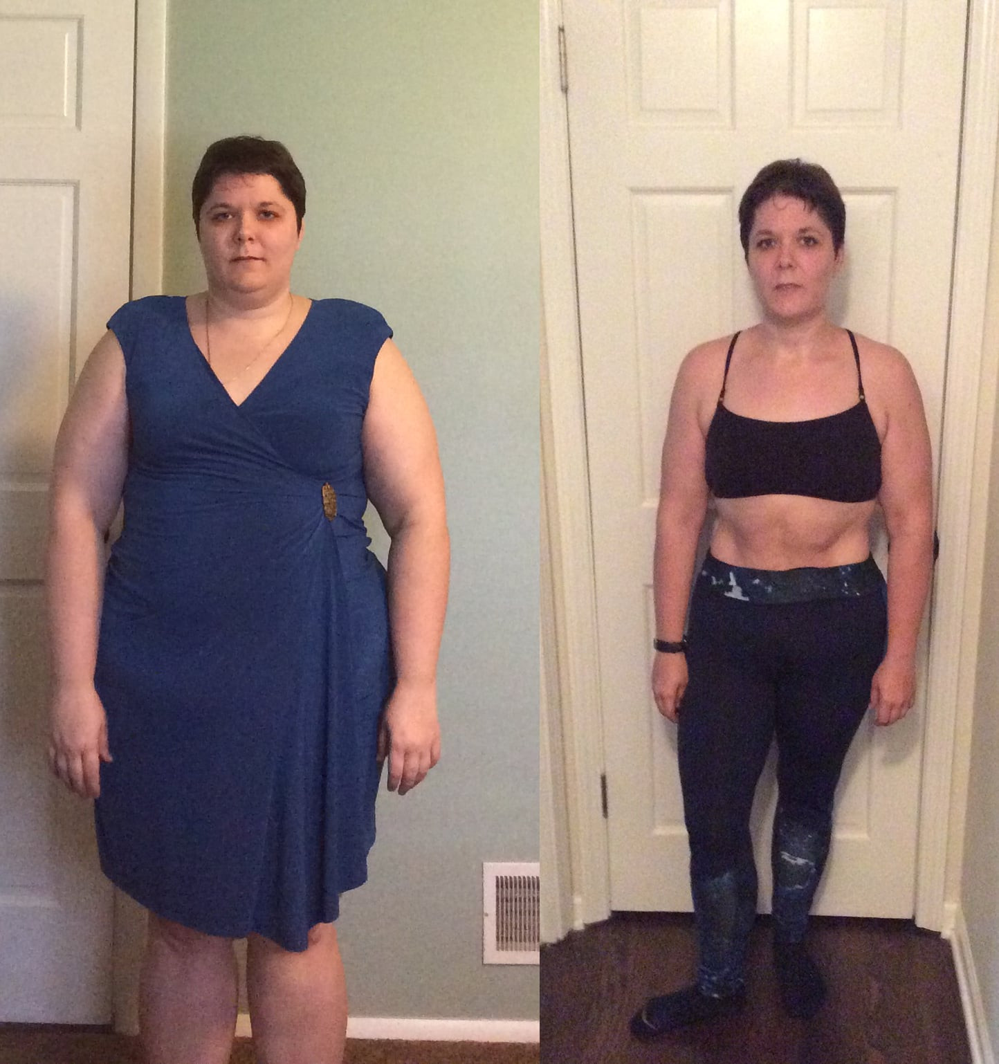 Vsg Before And After Sleeve Weight Loss Surgery
 Gastric Sleeve Surgery Weight Loss Transformation