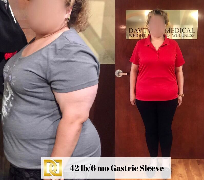 Weight Loss Surgery Before And After
 Gastric Sleeve Surgery in Los Angeles