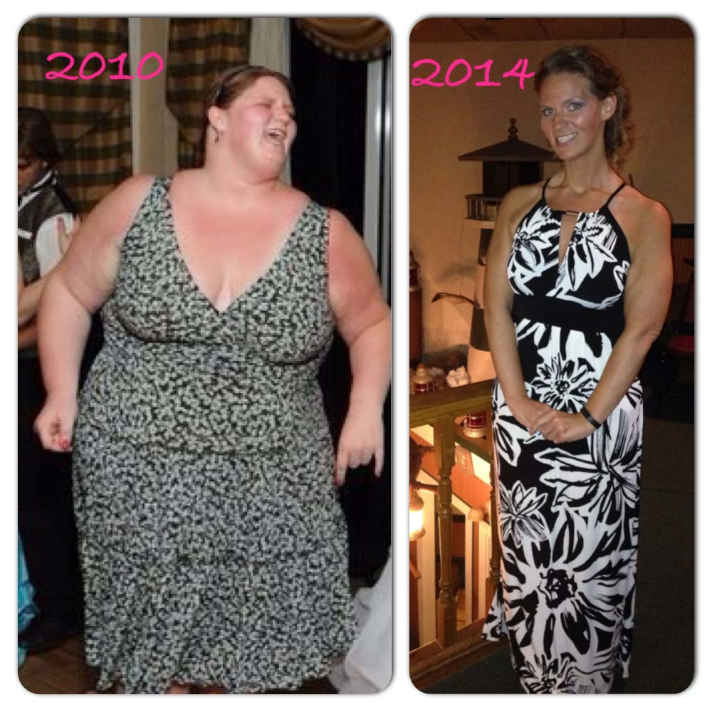 Weight Loss Surgery Before And After
 Lap Band Surgery Michele s Before And After Story