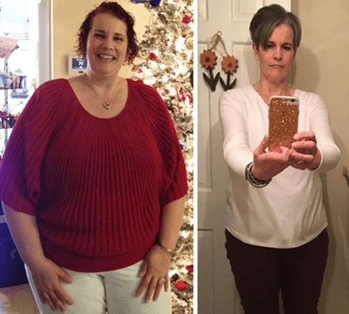 Weight Loss Surgery Before And After
 Our Weight Loss Surgery Patients their Tips for