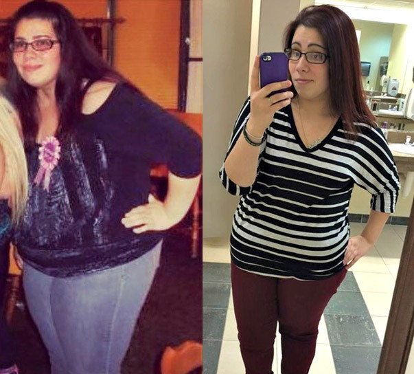 Weight Loss Surgery Before And After
 A 20 Something Bariatric Success Story in Progress