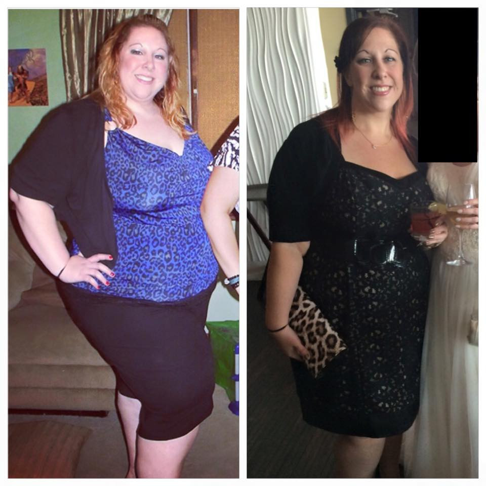 Weight Loss Surgery Before And After
 Gastric Sleeve Success Rate How Much Weight Will You