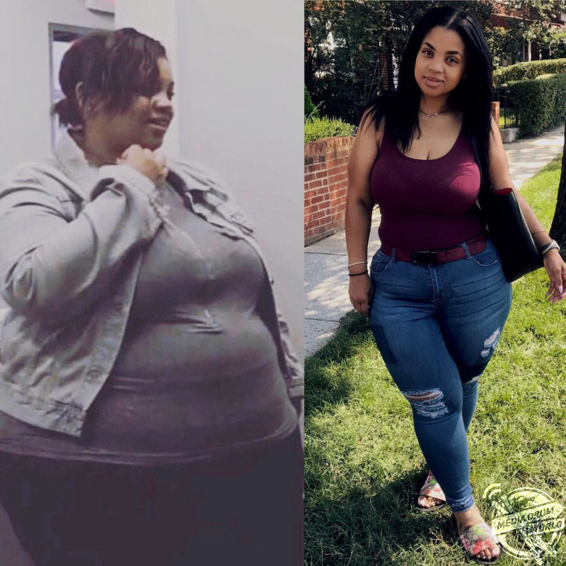 Weight Loss Surgery Before And After
 Incredible Woman Who Lost Eleven Stone in Fifteen Months