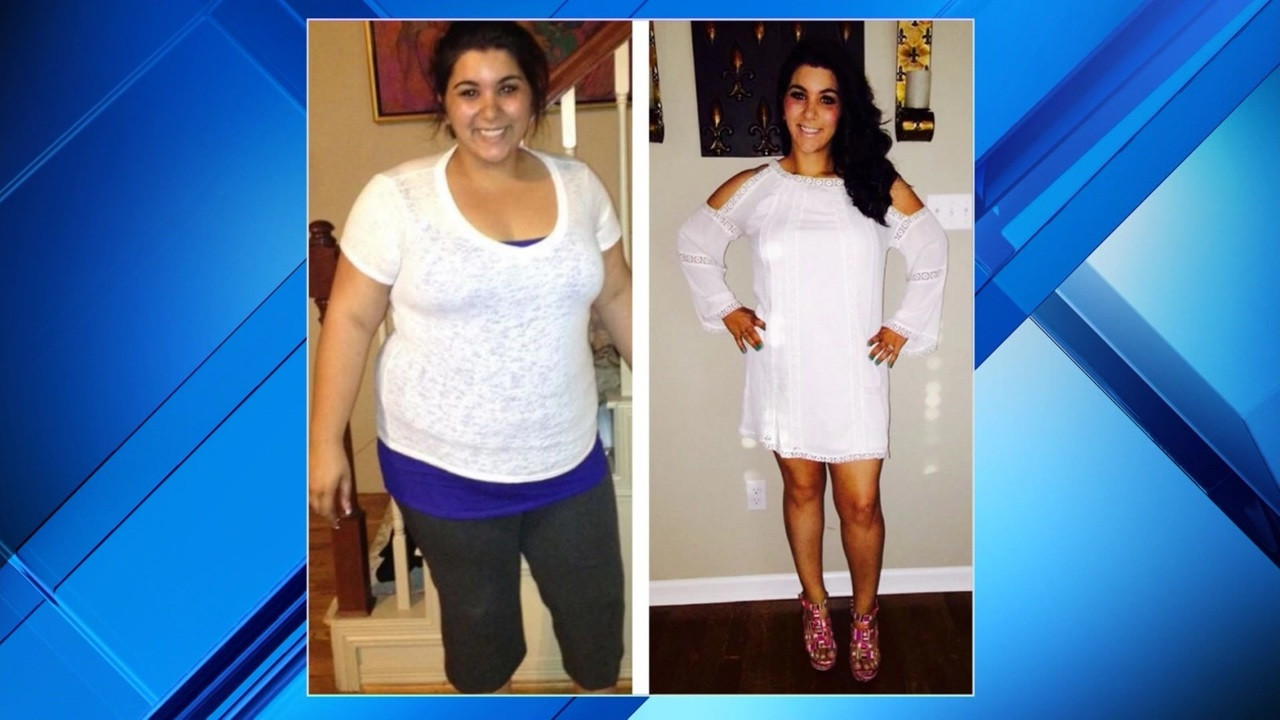 Weight Loss Surgery Before And After Pictures
 When to consider weight loss surgery