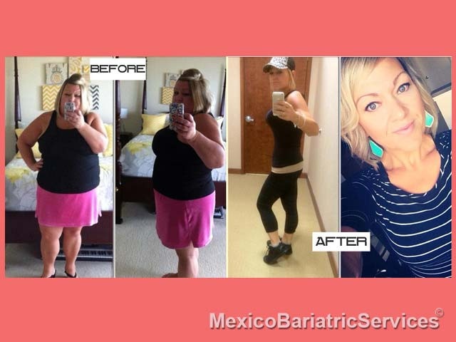 Weight Loss Surgery Before And After Success Story
 Weight Loss Surgery Success Stories