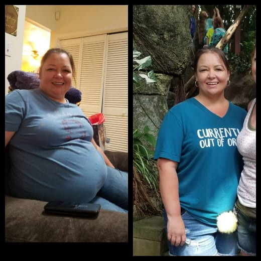 Weight Loss Surgery Before And After Success Story
 Gastric Bypass Surgery Before and After Past