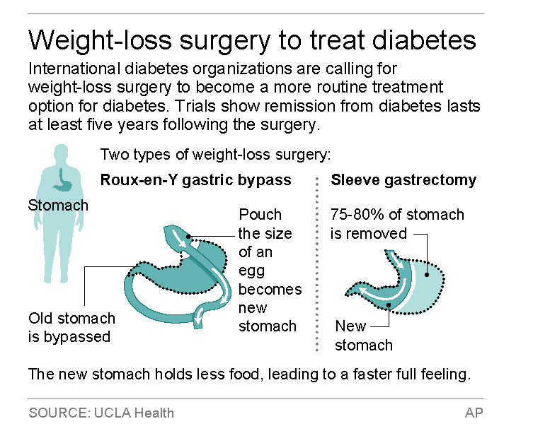 Weight Loss Surgery Requirements
 Use Obesity Surgery More ten for Diabetes Guidelines