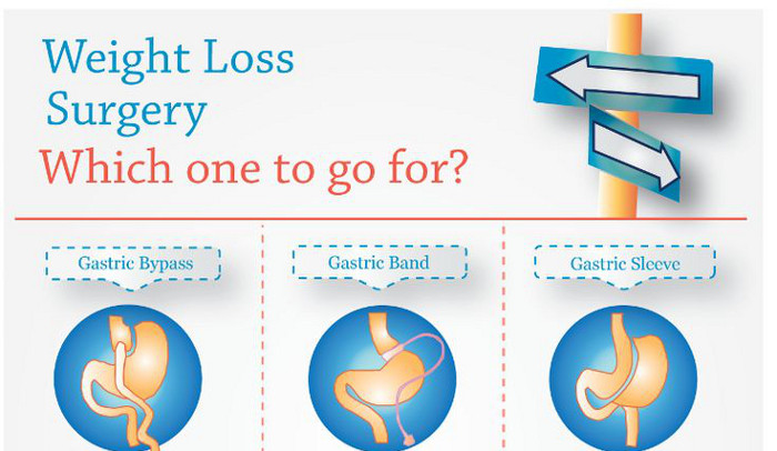 Weight Loss Surgery Requirements
 Gastric Sleeve Pros and Cons HRF
