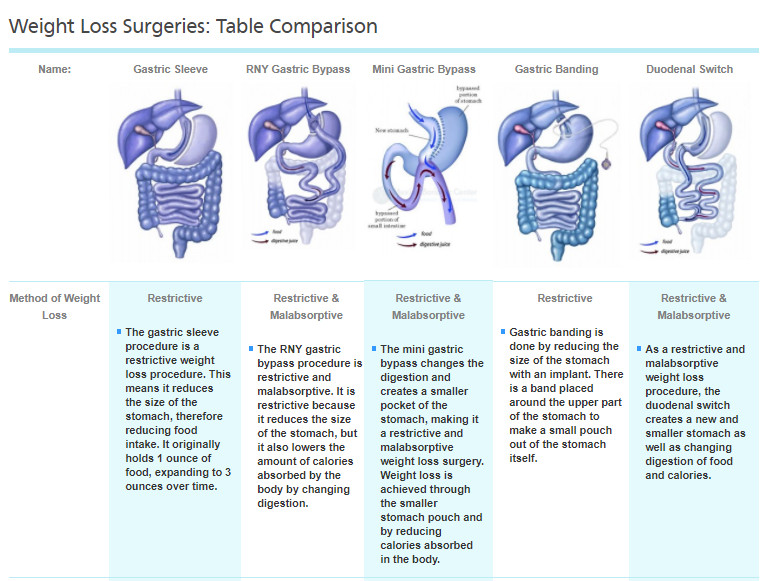 Weight Loss Surgery Requirements
 Bariatric Surgery Options Which Option is Best for Me
