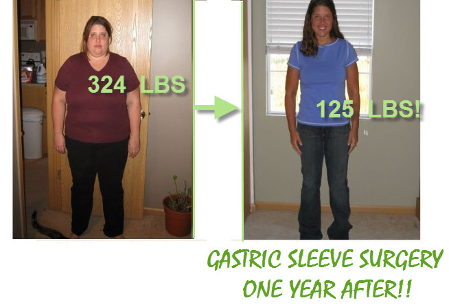 Weight Loss Surgery Sleeve
 Gastric Sleeve Surgery before and after pictures